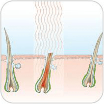 Anwendung von IPL auf der Haut